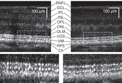 FIGURE 2. An ultrabroadband superluminescent diode improves resolution in images of a 0.5 mm section of a healthy retina. The improved AO-UHR-OCT system incorporated a source with 3.5 µm axial resolution in tissue (dashed rectangle, top right, magnified in bottom right), which shows reduced speckle size in comparison with an AO-OCT system with 6.5 µm axial resolution (dashed rectangle, top left, magnified in bottom left). FIGURE 2. An ultrabroadband superluminescent diode improves resolution in images of a 0.5 mm section of a healthy retina. The improved AO-UHR-OCT system incorporated a source with 3.5 µm axial resolution in tissue (dashed rectangle, top right, magnified in bottom right), which shows reduced speckle size in comparison with an AO-OCT system with 6.5 µm axial resolution (dashed rectangle, top left, magnified in bottom left).