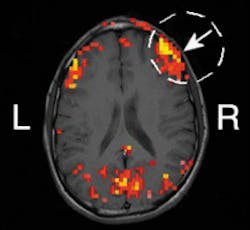 In five out of seven humans tested in a recent experiment, scientists at the University of Illinois demonstrated the correlation between hemodynamic signals obtained with frequency-domain near-IR spectroscopy and functional MRI. The arrow in the image indicates the location of the optical center. The yellow color corresponds to the highest area of correlation.