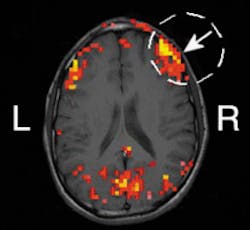 In five out of seven humans tested in a recent experiment, scientists at the University of Illinois demonstrated the correlation between hemodynamic signals obtained with frequency-domain near-IR spectroscopy and functional MRI. The arrow in the image indicates the location of the optical center. The yellow color corresponds to the highest area of correlation. In five out of seven humans tested in a recent experiment, scientists at the University of Illinois demonstrated the correlation between hemodynamic signals obtained with frequency-domain near-IR spectroscopy and functional MRI. The arrow in the image indicates the location of the optical center. The yellow color corresponds to the highest area of correlation.