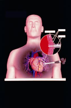 FIGURE 1. In transmyocardial revascularization, laser energy is used to create channels through the myocardium into the left ventricle, allowing oxygen-rich blood to flow into previously deprived heart muscle, thereby relieving angina and other symptoms of severe coronary artery disease. FIGURE 1. In transmyocardial revascularization, laser energy is used to create channels through the myocardium into the left ventricle, allowing oxygen-rich blood to flow into previously deprived heart muscle, thereby relieving angina and other symptoms of severe coronary artery disease.