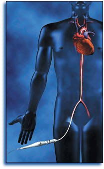 FIGURE 2. Percutaneous myocardial revascularization is similar to transmyocardial revascularization except that laser energy is delivered through a fiberoptic catheter that is inserted into the left ventricle via the femoral artery, and the channels are drilled from the inside out. FIGURE 2. Percutaneous myocardial revascularization is similar to transmyocardial revascularization except that laser energy is delivered through a fiberoptic catheter that is inserted into the left ventricle via the femoral artery, and the channels are drilled from the inside out.