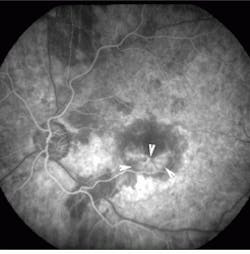 FIGURE 1. Arrows demarcate borders of the subfoveal choroidal neovascular membrane prior to treatment in an eye with age-related macular degeneration. FIGURE 1. Arrows demarcate borders of the subfoveal choroidal neovascular membrane prior to treatment in an eye with age-related macular degeneration.
