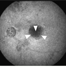 FIGURE 2. Closure of the subfoveal choroidal neovascularization was achieved with photodynamic therapy using Purlytin. FIGURE 2. Closure of the subfoveal choroidal neovascularization was achieved with photodynamic therapy using Purlytin.