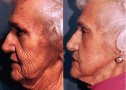 FIGURE 1. Before and after pictures of carbon dioxide laser skin resurfacing show the results that can be achieved with this procedure. Typical healing time is three to four weeks, though redness can remain for up to four months. FIGURE 1. Before and after pictures of carbon dioxide laser skin resurfacing show the results that can be achieved with this procedure. Typical healing time is three to four weeks, though redness can remain for up to four months.