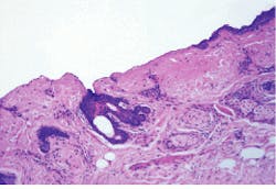 FIGURE 2. Research has shown that a single pulse from a 2.94-µm erbium laser can remove the epidermis with little to no collateral thermal damage. The pink section in the center is the dermis that remains following irradiation from a single pulse of an Er:YAG laser; the darker blue sections on the periphery are areas of the epidermis that were not treated. FIGURE 2. Research has shown that a single pulse from a 2.94-µm erbium laser can remove the epidermis with little to no collateral thermal damage. The pink section in the center is the dermis that remains following irradiation from a single pulse of an Er:YAG laser; the darker blue sections on the periphery are areas of the epidermis that were not treated.