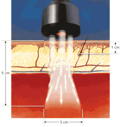 FIGURE 1. The ML830 from MicroLight uses three 830 nm laser diodes to penetrate skin to a depth of about 2 in. A red LED guides the collimated output from the laser diodes; the beams diverge slightly as they are absorbed and/or pass through different tissue layers. FIGURE 1. The ML830 from MicroLight uses three 830 nm laser diodes to penetrate skin to a depth of about 2 in. A red LED guides the collimated output from the laser diodes; the beams diverge slightly as they are absorbed and/or pass through different tissue layers.