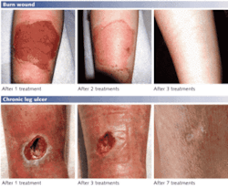 FIGURE 2. Phototherapy uses a combination of laser wavelengths to completely heal wounds that, in many chronic cases, did not heal using conventional treatments. FIGURE 2. Phototherapy uses a combination of laser wavelengths to completely heal wounds that, in many chronic cases, did not heal using conventional treatments.