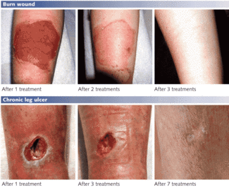 FIGURE 2. Phototherapy uses a combination of laser wavelengths to completely heal wounds that, in many chronic cases, did not heal using conventional treatments.
