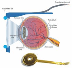 FIGURE 2. A schematic shows how a retinal implant called EPIRET3 works in the human ocular system. The actual EPIRET3 implant (bottom) consists of a silicone lens with integrated electronic components, along with stimulation electrodes. FIGURE 2. A schematic shows how a retinal implant called EPIRET3 works in the human ocular system. The actual EPIRET3 implant (bottom) consists of a silicone lens with integrated electronic components, along with stimulation electrodes.