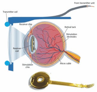 FIGURE 2. A schematic shows how a retinal implant called EPIRET3 works in the human ocular system. The actual EPIRET3 implant (bottom) consists of a silicone lens with integrated electronic components, along with stimulation electrodes.
