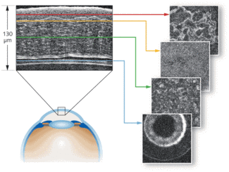 OPTICAL COHERENCE TOMOGRAPHY Fullfield OCT approaches clinical
