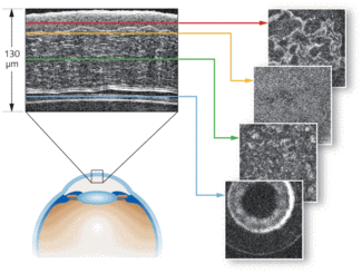 OPTICAL COHERENCE TOMOGRAPHY: Full-field OCT approaches clinical ...