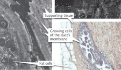 FIGURE 3. Cell OCT&rsquo;s fine resolution enables zooming in from a 10 &times; 3 mm image of a benign breast tumor (upper right) to a more detailed view (left) that compares with a histology section (lower right). It is possible to see connective tissue and the cells within the duct membrane in the histology section and the Cell OCT detail.