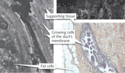 FIGURE 3. Cell OCT’s fine resolution enables zooming in from a 10 × 3 mm image of a benign breast tumor (upper right) to a more detailed view (left) that compares with a histology section (lower right). It is possible to see connective tissue and the cells within the duct membrane in the histology section and the Cell OCT detail. FIGURE 3. Cell OCT’s fine resolution enables zooming in from a 10 × 3 mm image of a benign breast tumor (upper right) to a more detailed view (left) that compares with a histology section (lower right). It is possible to see connective tissue and the cells within the duct membrane in the histology section and the Cell OCT detail.