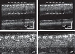FIGURE 3. Frame averaging improves images of inner retina layers of a healthy 55-year-old volunteer. Single-frame image (top left, magnified in bottom left) and 10 frame-averaged images (top right, magnified in bottom right) were obtained with an AO-UHR-OCT system.
