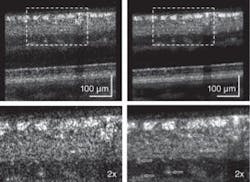 FIGURE 3. Frame averaging improves images of inner retina layers of a healthy 55-year-old volunteer. Single-frame image (top left, magnified in bottom left) and 10 frame-averaged images (top right, magnified in bottom right) were obtained with an AO-UHR-OCT system. FIGURE 3. Frame averaging improves images of inner retina layers of a healthy 55-year-old volunteer. Single-frame image (top left, magnified in bottom left) and 10 frame-averaged images (top right, magnified in bottom right) were obtained with an AO-UHR-OCT system.