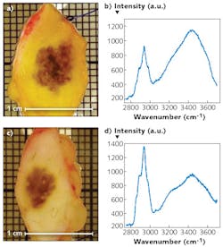 FIGURE 3. Photographs and Raman spectra obtained with the experimental setup of pigmented human tissue indicating melanoma (a, b) and benign melanocytic tissue (b, c). Laser wavelength: 976 nm, exposure time: 10 s. FIGURE 3. Photographs and Raman spectra obtained with the experimental setup of pigmented human tissue indicating melanoma (a, b) and benign melanocytic tissue (b, c). Laser wavelength: 976 nm, exposure time: 10 s.