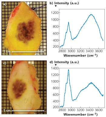 FIGURE 3. Photographs and Raman spectra obtained with the experimental setup of pigmented human tissue indicating melanoma (a, b) and benign melanocytic tissue (b, c). Laser wavelength: 976 nm, exposure time: 10 s.