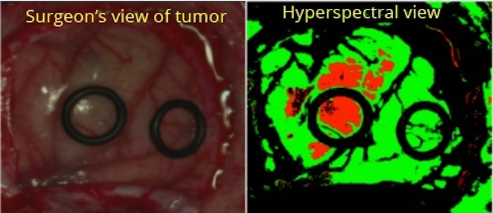 Hyperspectral imagers from Headwall image in the visible and near-infrared region to identify tumor margins--not visible with the naked eye--for surgery as part of the HELICoiD project. (Image credit: Headwall Photonics)