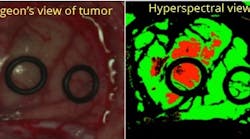 Hyperspectral imagers from Headwall image in the visible and near-infrared region to identify tumor margins--not visible with the naked eye--for surgery as part of the HELICoiD project.