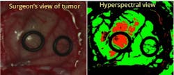 Hyperspectral imagers from Headwall image in the visible and near-infrared region to identify tumor margins--not visible with the naked eye--for surgery as part of the HELICoiD project. Hyperspectral imagers from Headwall image in the visible and near-infrared region to identify tumor margins--not visible with the naked eye--for surgery as part of the HELICoiD project.