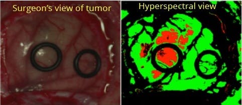 Hyperspectral imagers from Headwall image in the visible and near-infrared region to identify tumor margins--not visible with the naked eye--for surgery as part of the HELICoiD project.