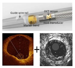 Content Dam Bow Online Articles 2016 05 Dual Oct Ivus Catheter Content Dam Bow Online Articles 2016 05 Dual Oct Ivus Catheter