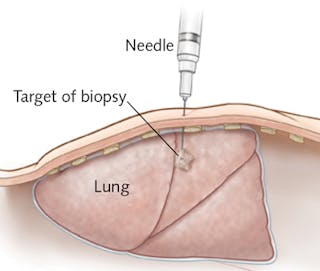 Precise placement of the probe tip in needle biopsy is one application that the InSPECT project aims to address; the result would be improved accuracy in cancer diagnosis and treatment. But the consortium envisions many other uses in biomedicine and beyond.
