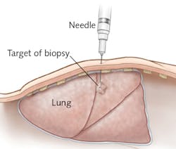 Precise placement of the probe tip in needle biopsy is one application that the InSPECT project aims to address; the result would be improved accuracy in cancer diagnosis and treatment. But the consortium envisions many other uses in biomedicine and beyond. Precise placement of the probe tip in needle biopsy is one application that the InSPECT project aims to address; the result would be improved accuracy in cancer diagnosis and treatment. But the consortium envisions many other uses in biomedicine and beyond.