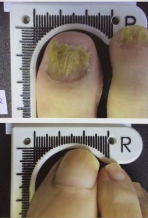 FDA clears lowlevel laser therapy device for nail fungus Laser Focus World
