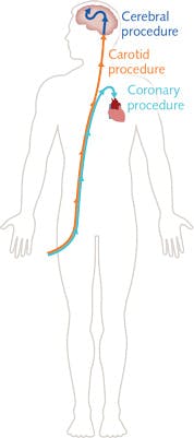 FIGURE 2. A schematic shows the route taken through the human body by a catheter used for coronary, carotid, and cerebral procedures.