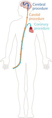 FIGURE 2. A schematic shows the route taken through the human body by a catheter used for coronary, carotid, and cerebral procedures. FIGURE 2. A schematic shows the route taken through the human body by a catheter used for coronary, carotid, and cerebral procedures.