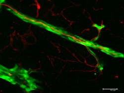 Melanoma Cells Spreading Web Melanoma Cells Spreading Web