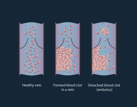 Content Dam Bow Online Articles 2016 09 Thrombosis 1 Web