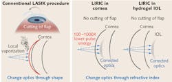FIGURE 1. Whereas LASIK corrects vision by using a laser to ablate and remove layers of tissue, and thereby change the shape of the cornea, LIRIC changes the focusing capability of the cornea&apos;s internal optics noninvasively.