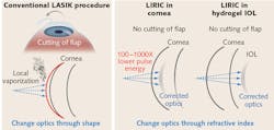 FIGURE 1. Whereas LASIK corrects vision by using a laser to ablate and remove layers of tissue, and thereby change the shape of the cornea, LIRIC changes the focusing capability of the cornea's internal optics noninvasively. FIGURE 1. Whereas LASIK corrects vision by using a laser to ablate and remove layers of tissue, and thereby change the shape of the cornea, LIRIC changes the focusing capability of the cornea's internal optics noninvasively.