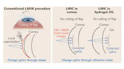 FIGURE 1. Whereas LASIK corrects vision by using a laser to ablate and remove layers of tissue, and thereby change the shape of the cornea, LIRIC changes the focusing capability of the cornea's internal optics noninvasively.