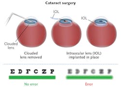 FIGURE 2. More than 50% of the 20 million cataract operations performed annually involve residual refractive error. Patients experiencing such unsatisfactory outcomes will be able to benefit from laser induced refractive index change (LIRIC).