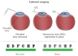 FIGURE 2. More than 50% of the 20 million cataract operations performed annually involve residual refractive error. Patients experiencing such unsatisfactory outcomes will be able to benefit from laser induced refractive index change (LIRIC). FIGURE 2. More than 50% of the 20 million cataract operations performed annually involve residual refractive error. Patients experiencing such unsatisfactory outcomes will be able to benefit from laser induced refractive index change (LIRIC).