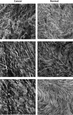 These second-harmonic-generation (SHG) images depict single optical sections of ex vivo human ovarian tissue. The malignant tumors are high-grade serous tumors as classified as pathology (left column). The field size in each case is 170 &times; 170 &mu;m. The images were acquired at 40X 0.8 NA at zoom 2 using 890 nm excitation in the forward detection, isolated with a bandpass filter, and detected by a single-photon-counting photomultiplier.