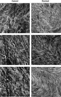 These second-harmonic-generation (SHG) images depict single optical sections of ex vivo human ovarian tissue. The malignant tumors are high-grade serous tumors as classified as pathology (left column). The field size in each case is 170 × 170 μm. The images were acquired at 40X 0.8 NA at zoom 2 using 890 nm excitation in the forward detection, isolated with a bandpass filter, and detected by a single-photon-counting photomultiplier. These second-harmonic-generation (SHG) images depict single optical sections of ex vivo human ovarian tissue. The malignant tumors are high-grade serous tumors as classified as pathology (left column). The field size in each case is 170 × 170 μm. The images were acquired at 40X 0.8 NA at zoom 2 using 890 nm excitation in the forward detection, isolated with a bandpass filter, and detected by a single-photon-counting photomultiplier.