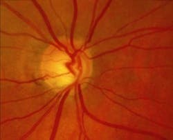 Content Dam Bow Online Articles 2016 12 Glaucoma Web Content Dam Bow Online Articles 2016 12 Glaucoma Web