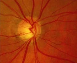 Content Dam Bow Online Articles 2016 12 Glaucoma Web Content Dam Bow Online Articles 2016 12 Glaucoma Web