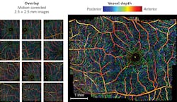 This depth-resolved image of retinal vasculature, actually a composite of multiple, sequentially acquired FD-DOCT A-scans, is the product of a technique developed to overcome motion artifacts. Superficial vessels appear in red, while the deepest vessels are blue. This depth-resolved image of retinal vasculature, actually a composite of multiple, sequentially acquired FD-DOCT A-scans, is the product of a technique developed to overcome motion artifacts. Superficial vessels appear in red, while the deepest vessels are blue.