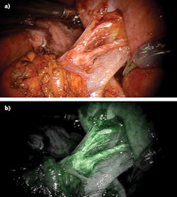 FIGURE 4. White light reflectance (a) and near-IR fluorescence (b) images of the renal hilum during robotic-assisted, minimally invasive partial nephrectomy. FIGURE 4. White light reflectance (a) and near-IR fluorescence (b) images of the renal hilum during robotic-assisted, minimally invasive partial nephrectomy.