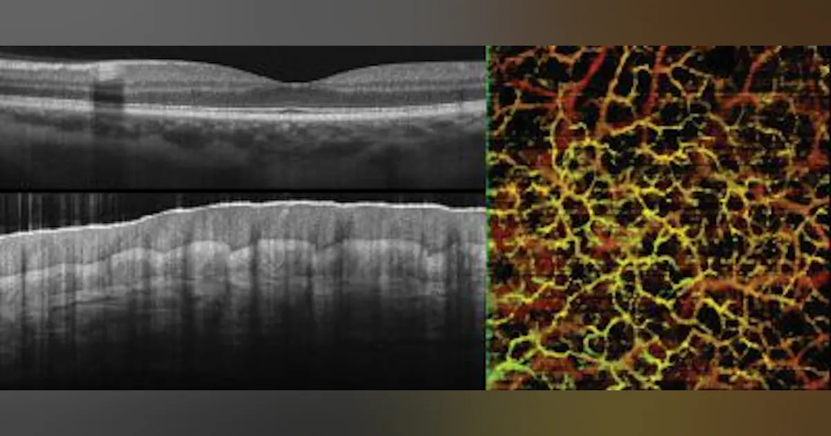 Spectral-domain OCT spectrometer addresses sensitivity, fall-off ...