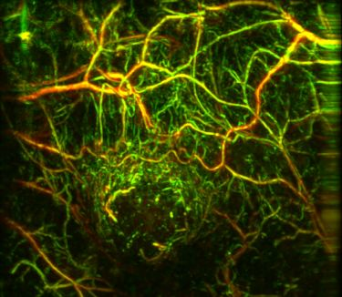 Content Dam Bow Online Articles 2017 03 Msot Tumor Web