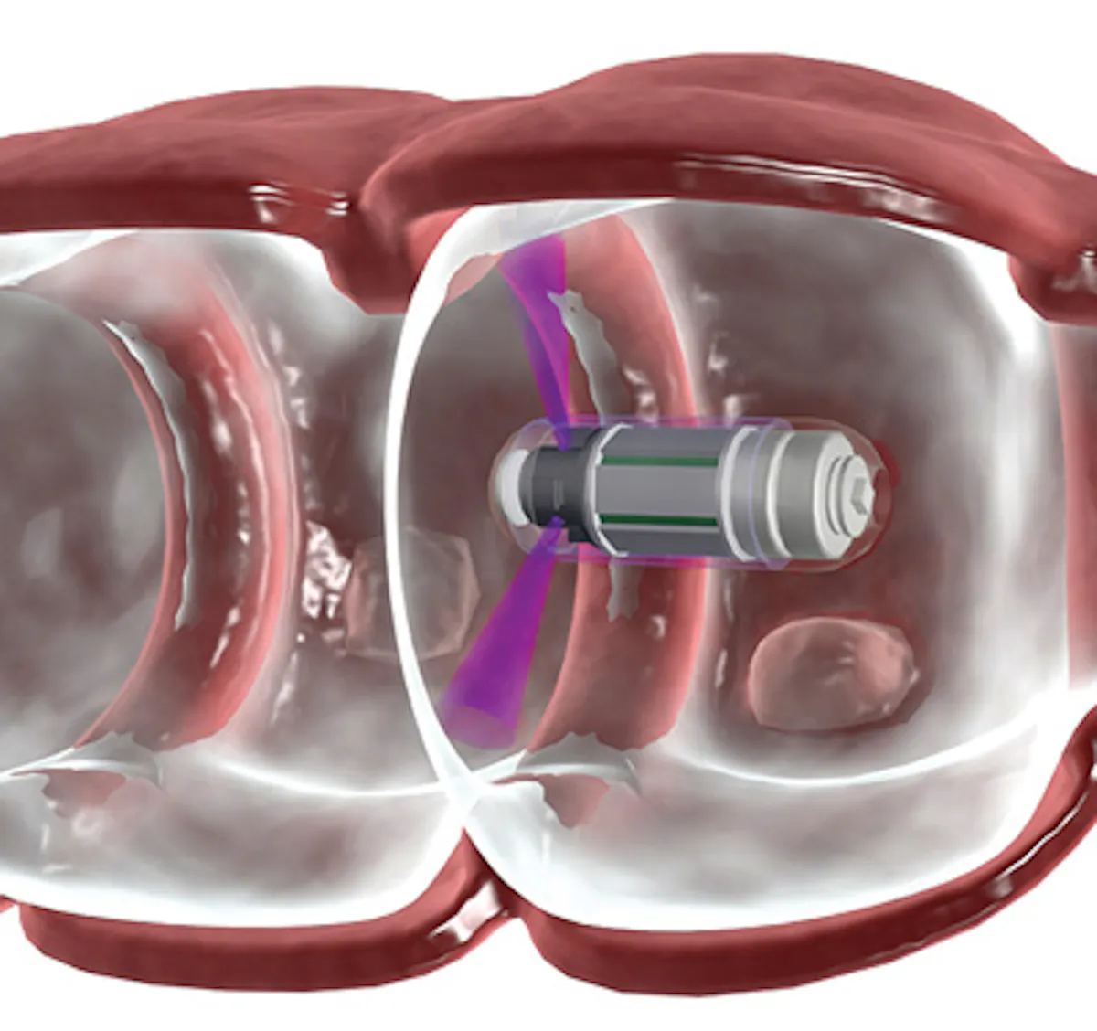 X-ray Imaging: Noninvasive colonoscopy comes without the yuck factor ...