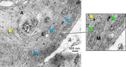 A transmission-electron-microscope image shows A549 cells incubated with AuNPs and single-walled carbon nanotubes at a concentration of 0.25mg/ml; yellow arrows point to AuNPs, blue arrows to mitochondria (M), and green arrows to endoplasmic reticulum. A transmission-electron-microscope image shows A549 cells incubated with AuNPs and single-walled carbon nanotubes at a concentration of 0.25mg/ml; yellow arrows point to AuNPs, blue arrows to mitochondria (M), and green arrows to endoplasmic reticulum.