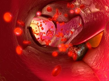 Content Dam Bow En Articles 2017 08 Spaser Detects And Destroys Circulating Tumor Cells To Prevent Cancer Metastases Leftcolumn Article Thumbnailimage File